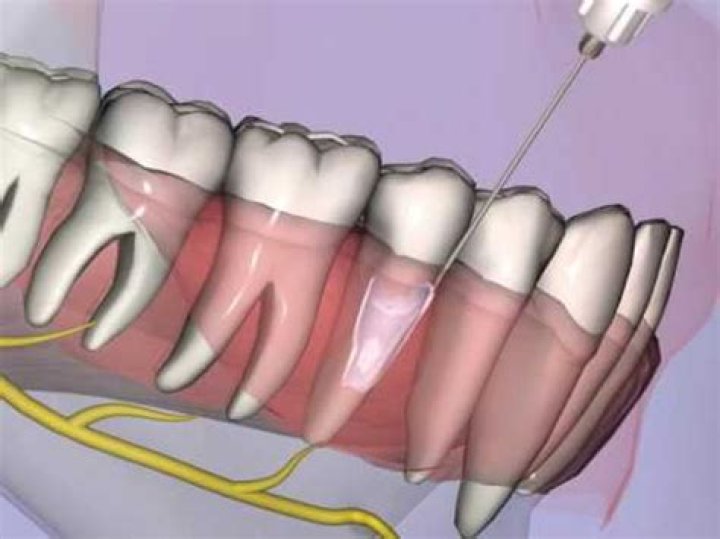 What is a PDL injection?