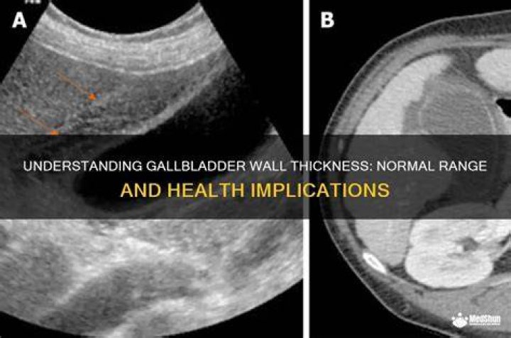 What is normal gallbladder wall thickness?